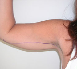Arm Reduction (Brachioplasty) Before Photo Arm Reduction (Brachioplasty)