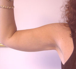 Arm Reduction (Brachioplasty) After Photo Arm Reduction (Brachioplasty)