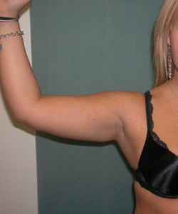 Arm Reduction (Brachioplasty) After Photo Arm Reduction (Brachioplasty)