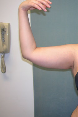 Arm Reduction (Brachioplasty)