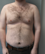 Pseudogynecomastia