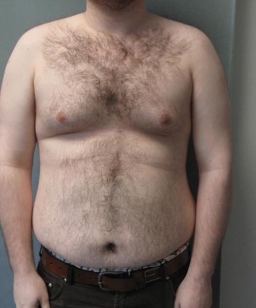 Pseudogynecomastia Before Photo Pseudogynecomastia