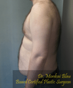 Pseudogynecomastia