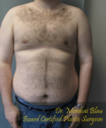 Pseudogynecomastia