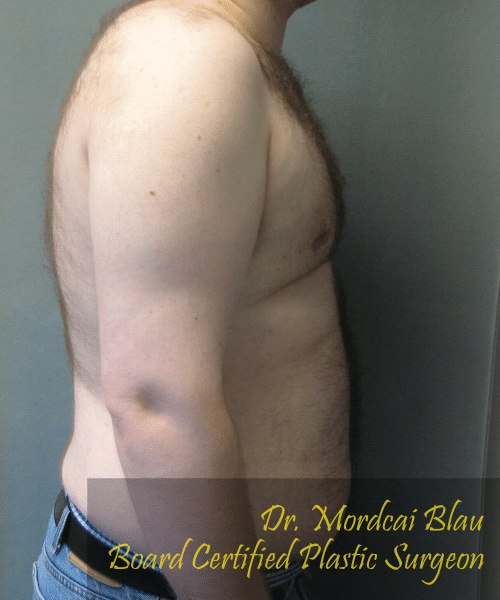 Pseudogynecomastia