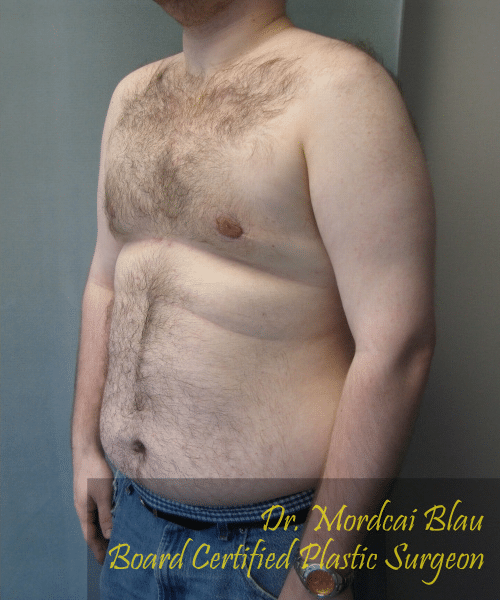 Pseudogynecomastia