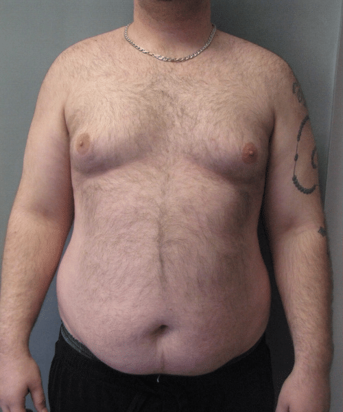 Pseudogynecomastia Before Photo Pseudogynecomastia