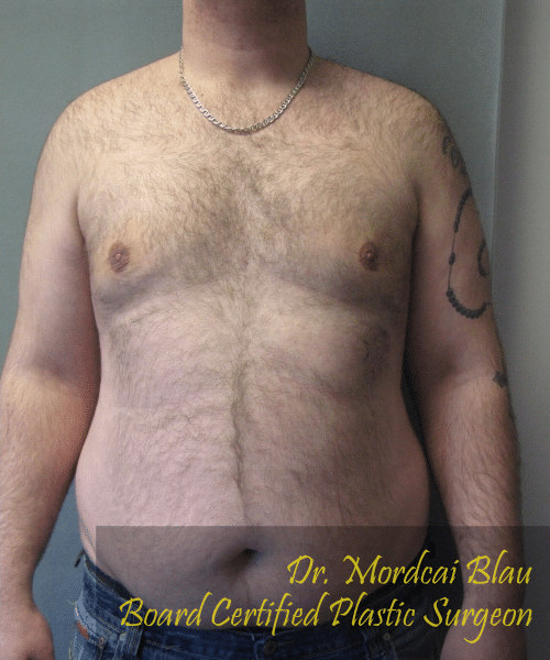 Pseudogynecomastia After Photo Pseudogynecomastia