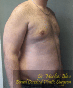 Pseudogynecomastia