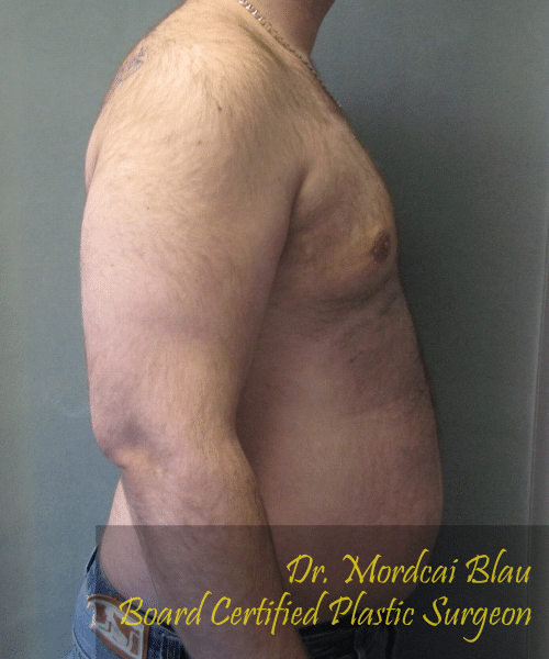 Pseudogynecomastia