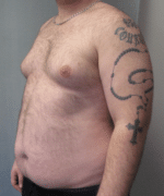 Pseudogynecomastia