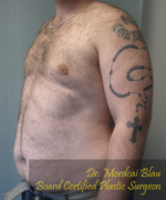 Pseudogynecomastia