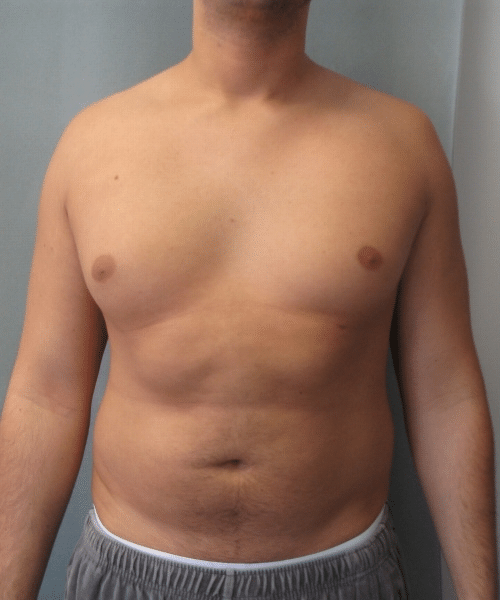 Pseudogynecomastia Before Photo Pseudogynecomastia
