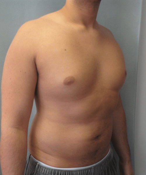 Pseudogynecomastia