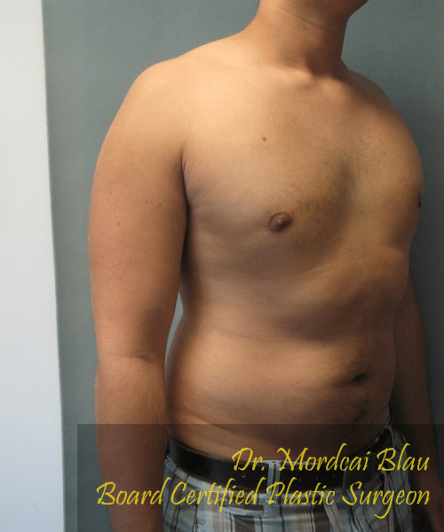 Pseudogynecomastia