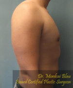 Pseudogynecomastia