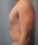 Pseudogynecomastia