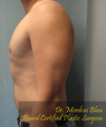 Pseudogynecomastia