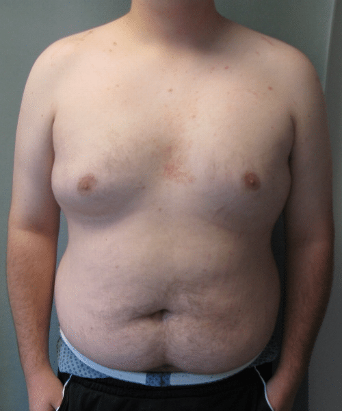 Pseudogynecomastia