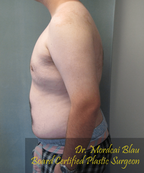 Pseudogynecomastia