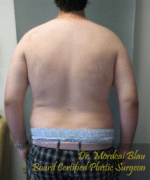 Pseudogynecomastia