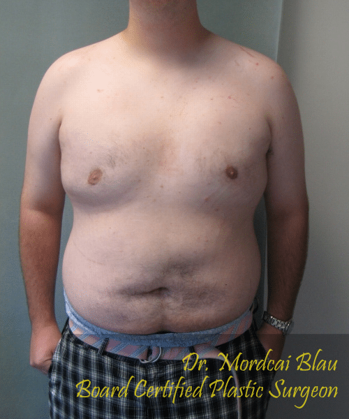 Pseudogynecomastia