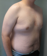 Pseudogynecomastia