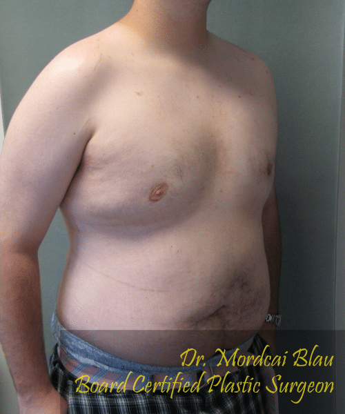 Pseudogynecomastia