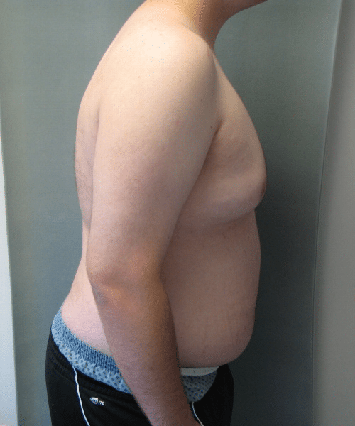 Pseudogynecomastia