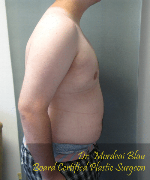 Pseudogynecomastia