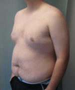 Pseudogynecomastia