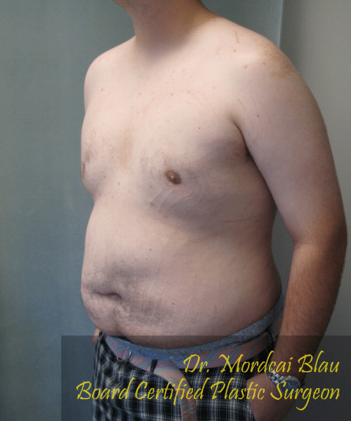 Pseudogynecomastia