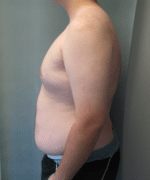 Pseudogynecomastia