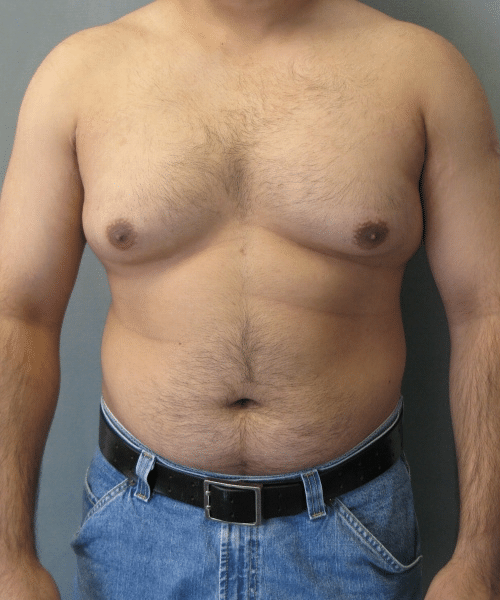 Pseudogynecomastia