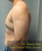 Pseudogynecomastia