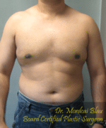 Pseudogynecomastia