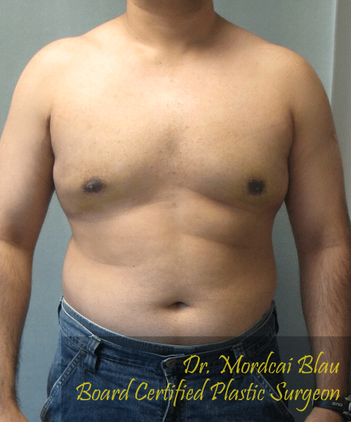 Pseudogynecomastia