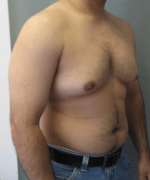 Pseudogynecomastia