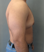 Pseudogynecomastia