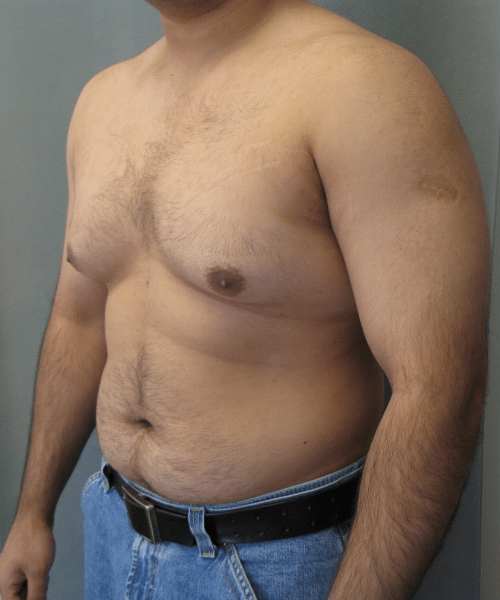 Pseudogynecomastia