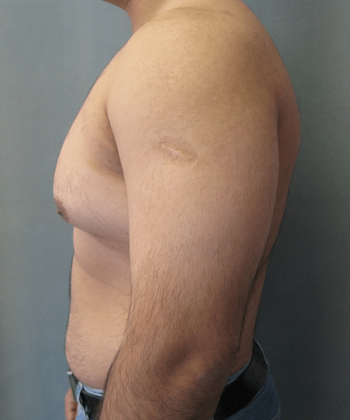 Pseudogynecomastia