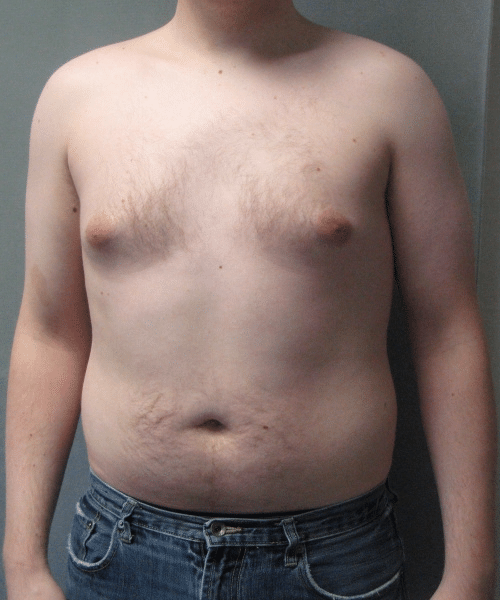 Pseudogynecomastia