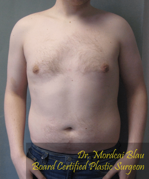 Pseudogynecomastia