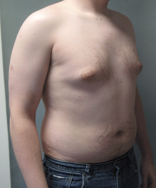 Pseudogynecomastia