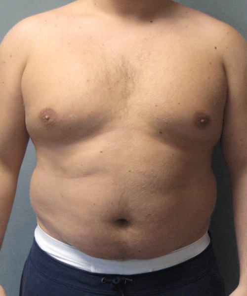 Pseudogynecomastia Before Photo Pseudogynecomastia