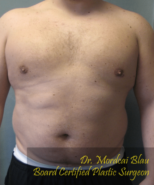 Pseudogynecomastia After Photo Pseudogynecomastia