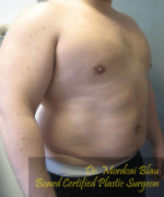 Pseudogynecomastia