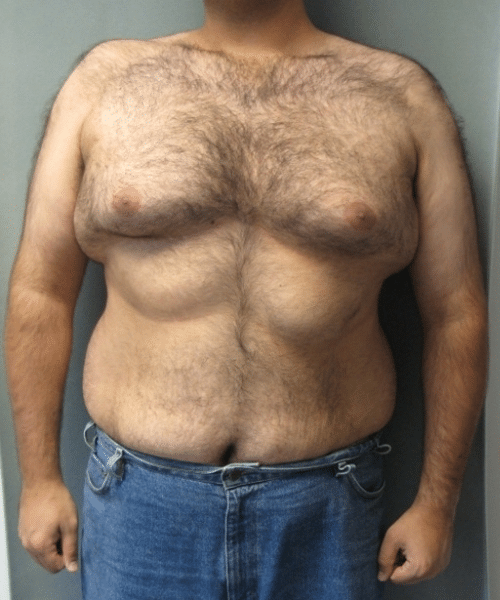 Pseudogynecomastia Before Photo Pseudogynecomastia