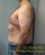 Pseudogynecomastia