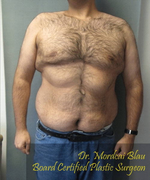 Pseudogynecomastia